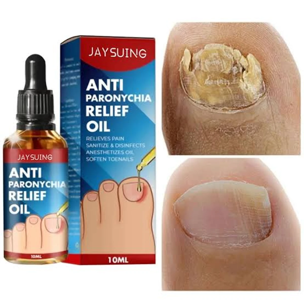 German Toenailplus NailProp Anti Paronychia Relief Oil